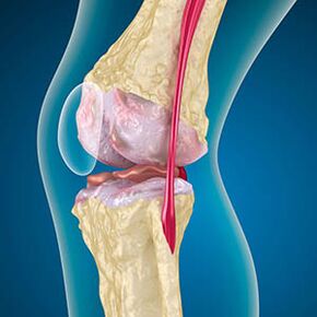 Excessive tension in the thigh muscles can stimulate knee pain