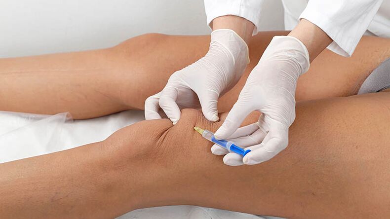 Intra-articular injection of knee arthritis