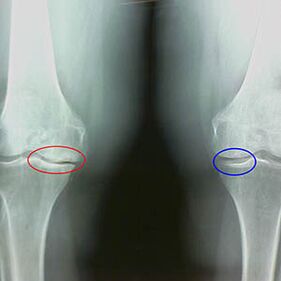 Radiography knee joints