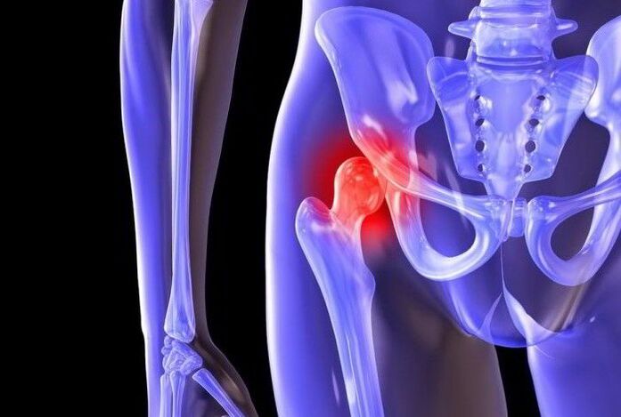 Pathological process of hip arthropathy