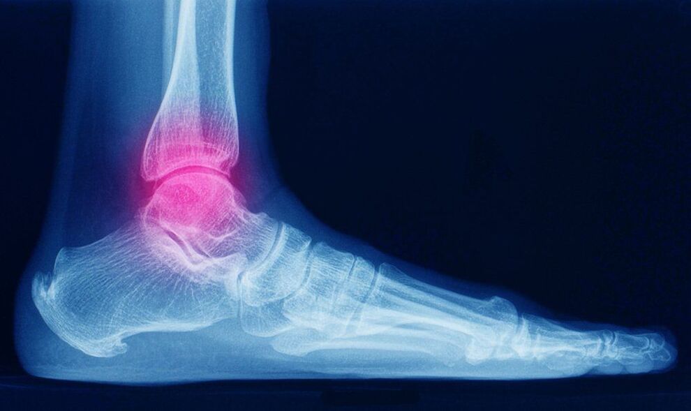 Symptoms of ankle arthritis